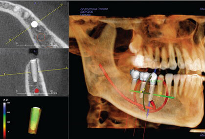 CBCT