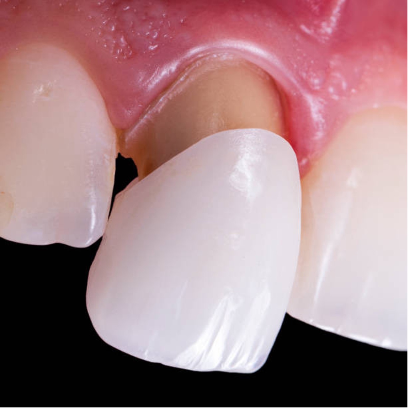 Dental crown in Lahore