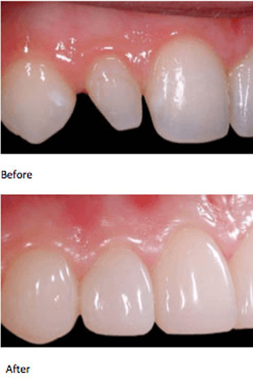 E- Max crown in Lahore