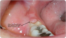 Teeth Extraction in Lahore, Pakistan