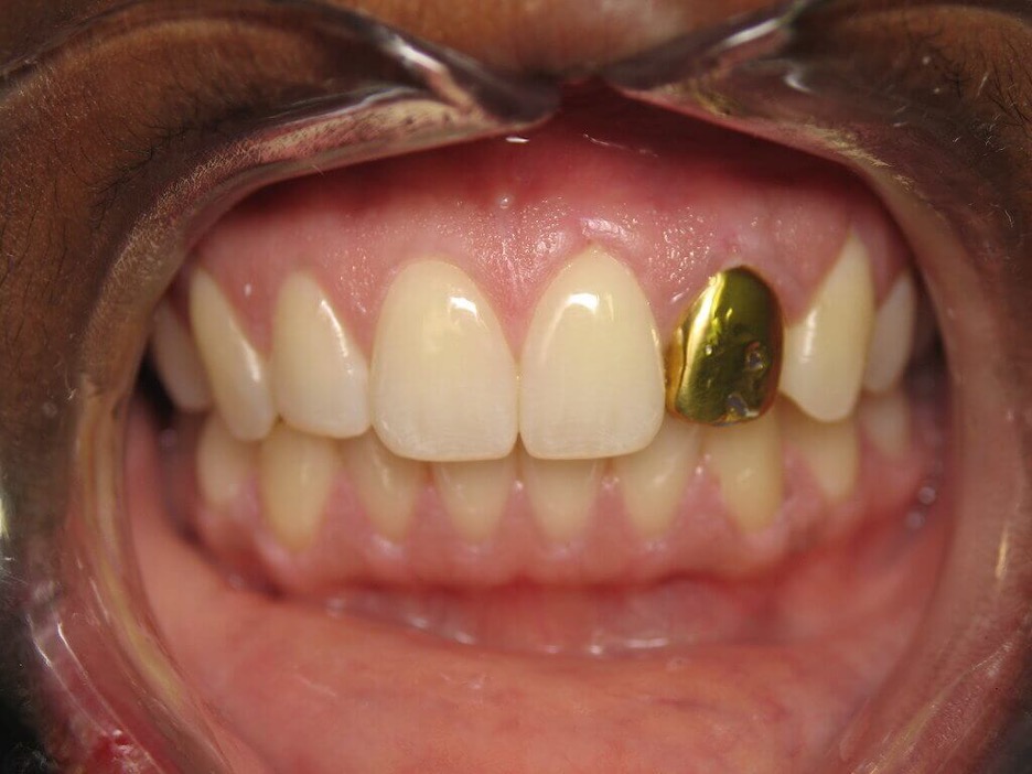 Gold crown Price in Lahore