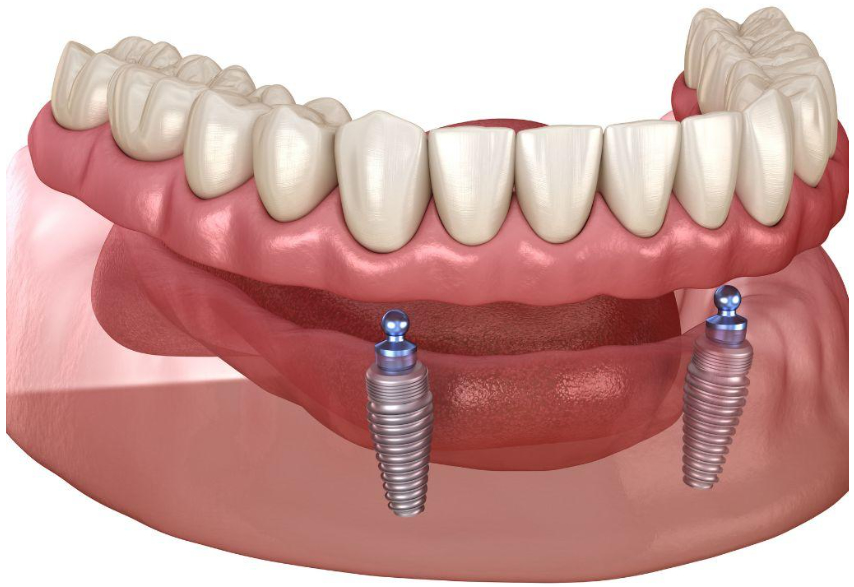 Implant supported Denture in Lahore