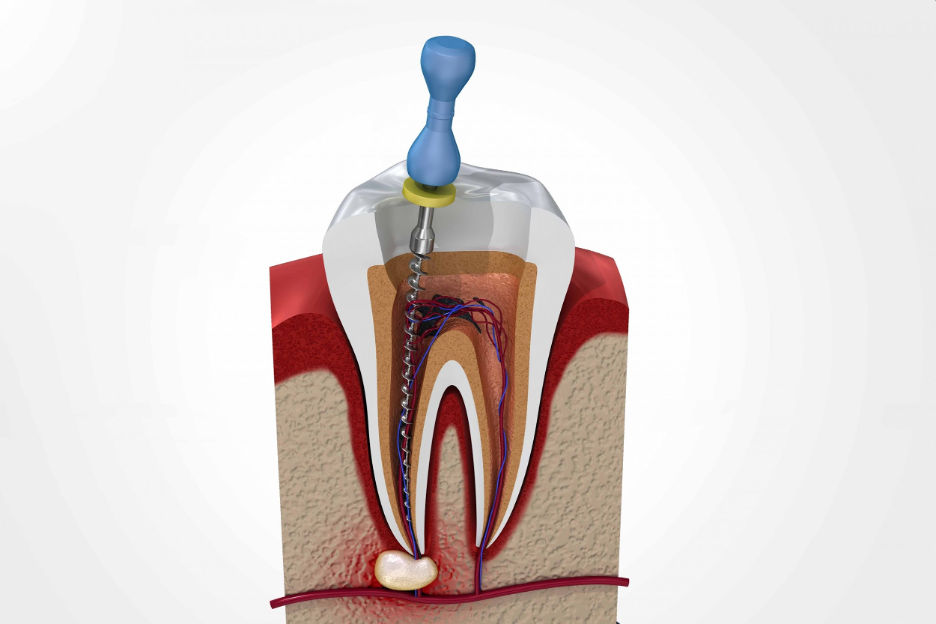 Manual root canal instruments