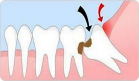 Teeth Extraction in Lahore, Pakistan