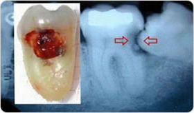 Teeth Extraction in Lahore, Pakistan