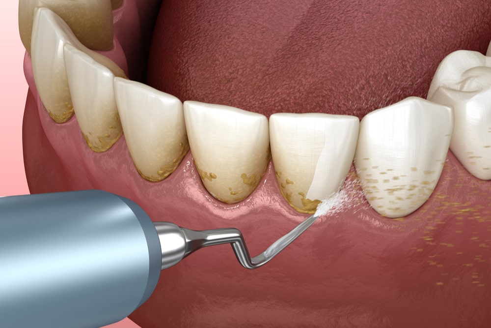 teeth scaling