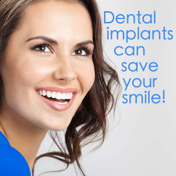 Dental Implant can save your smile