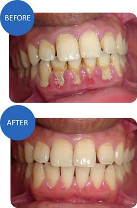 teeth polishing