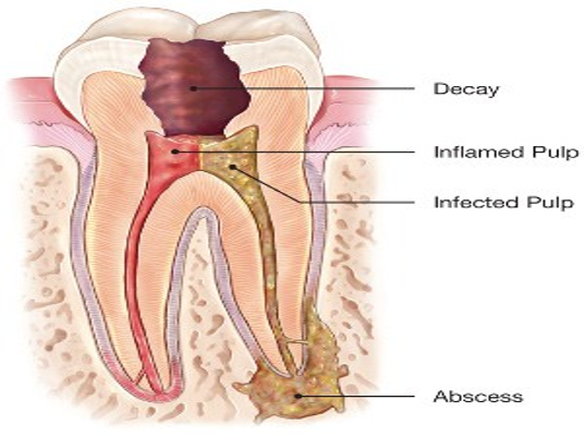 Best Root Canal Treatment Services in Lahore