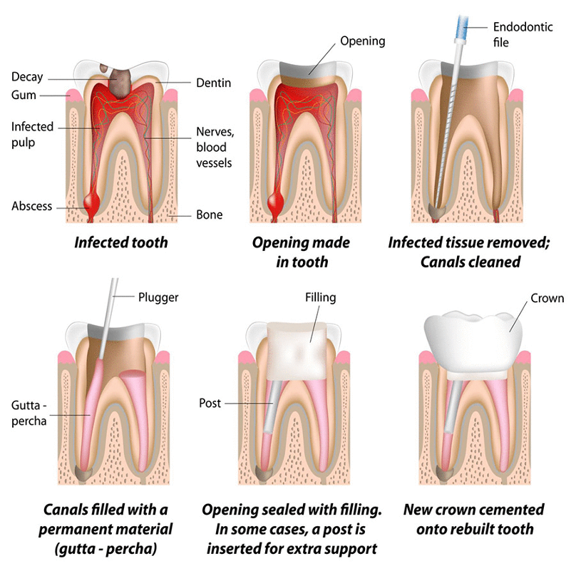 Best Root Canal Treatment Services in Lahore
