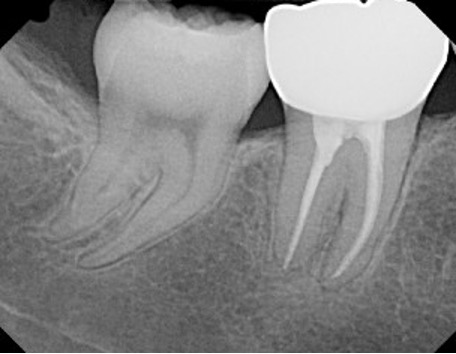 Best Root Canal Treatment Services in Lahore